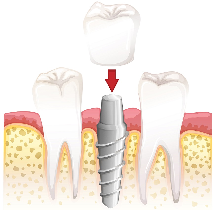 Implantaten