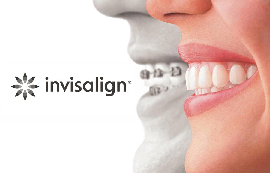 Invisalign Go beugel